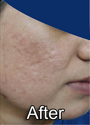 After-Acne (Pimples)