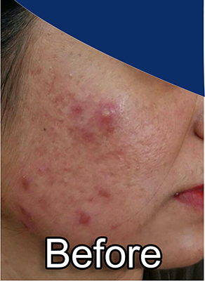 Before-Acne (Pimples)