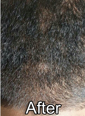 After-Alopecia-Areata