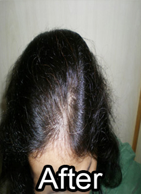 After-Alopecia