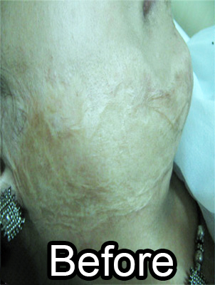 Before-Keloid