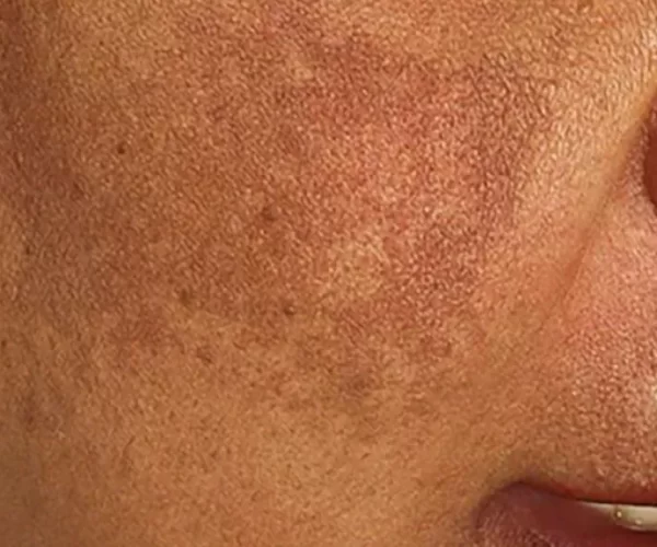 hyperpigmentation-skin-slide1-1024x575