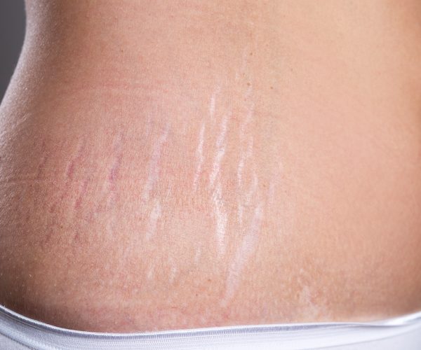 stretch-marks-feat-1