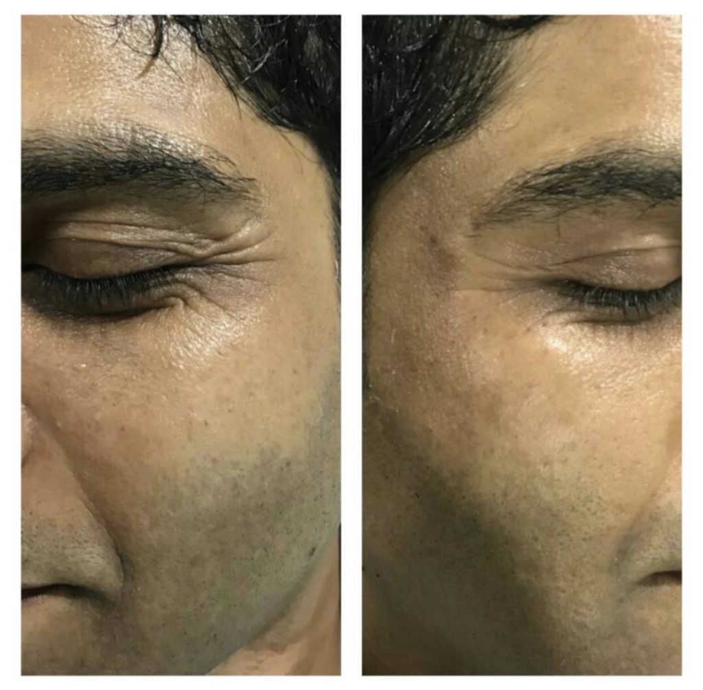 anti aging treatment indore