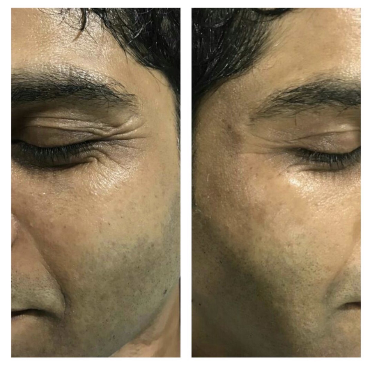 anti aging treatment indore