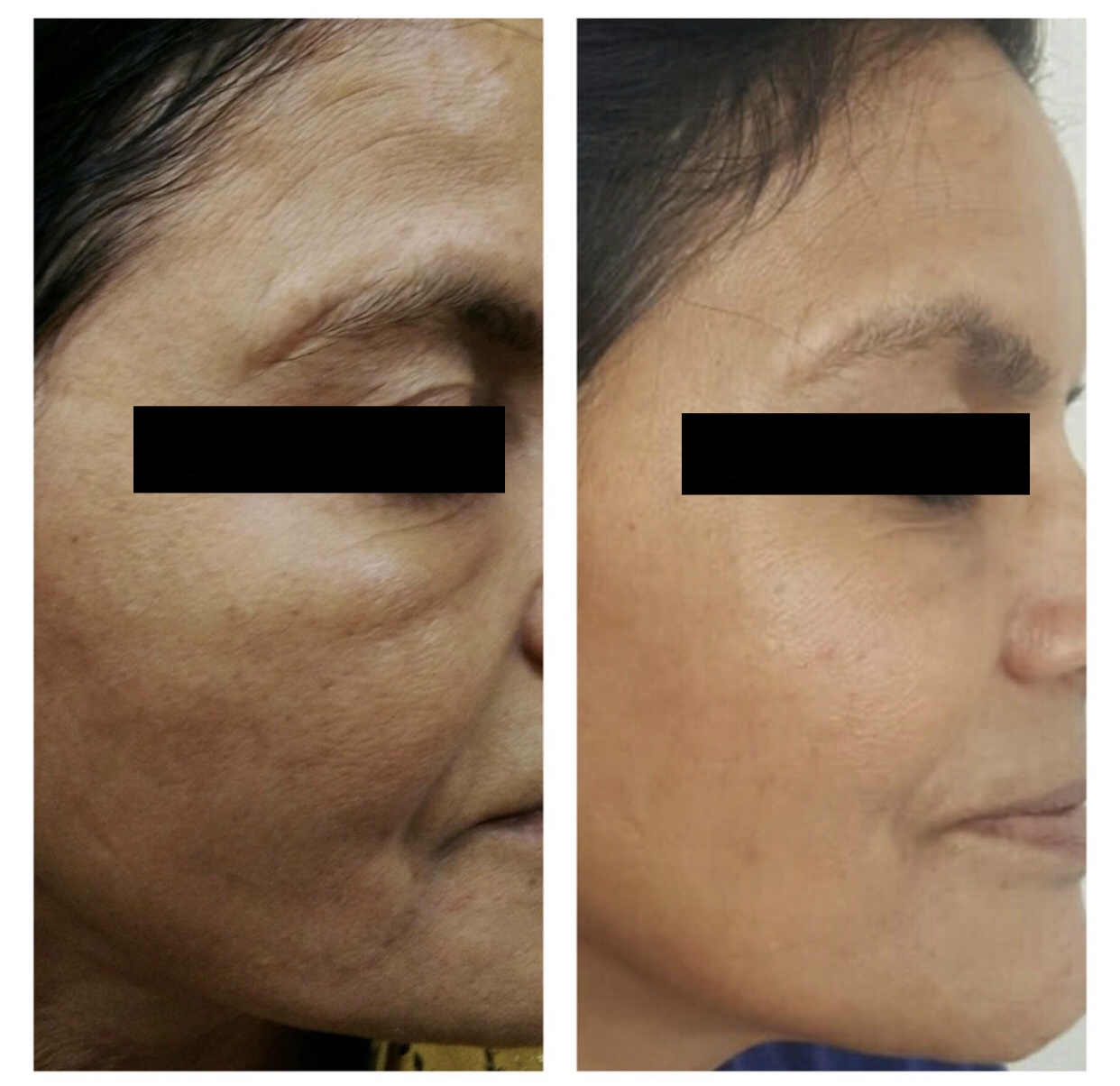 anti aging treatment indore