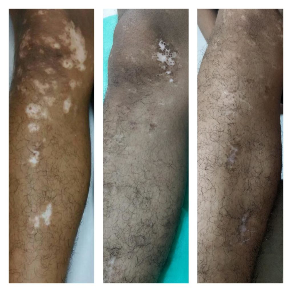 Vitiligo Treatment