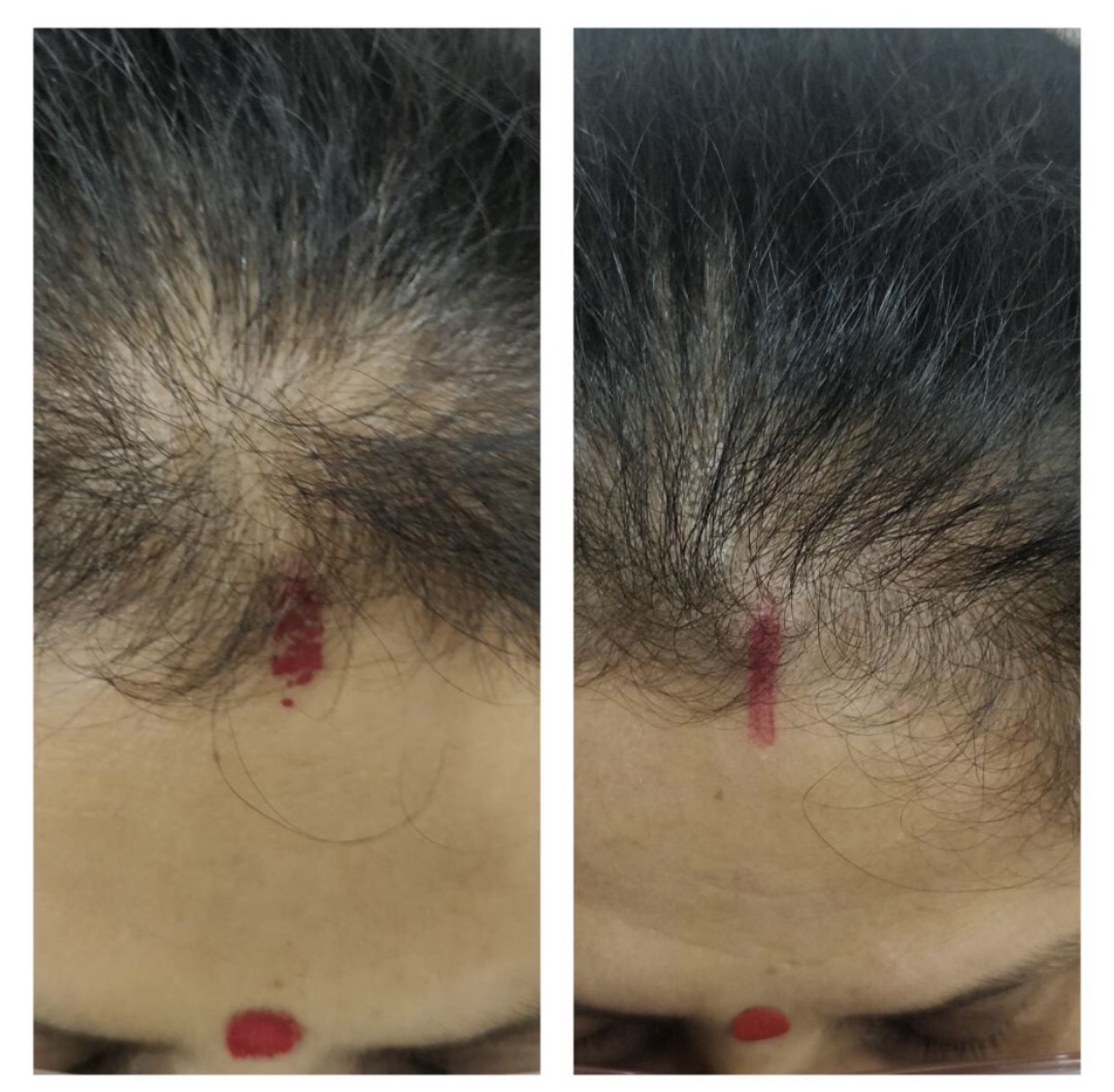 HAIR GROWTH TREATMENT