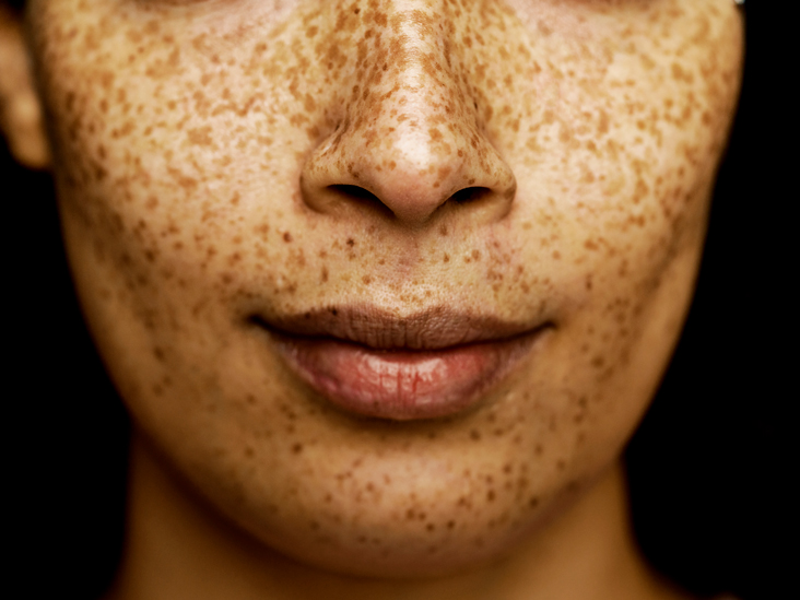 Freckle