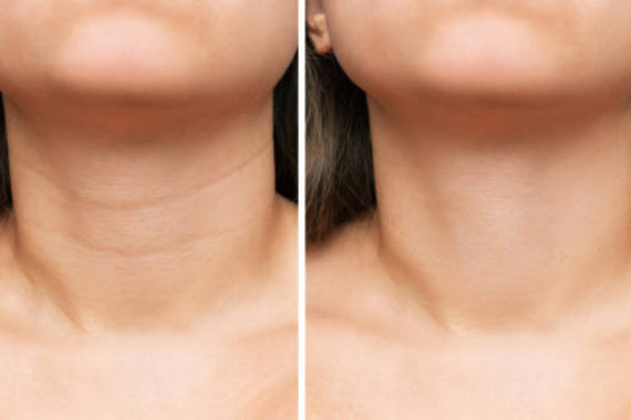 necklift in indore