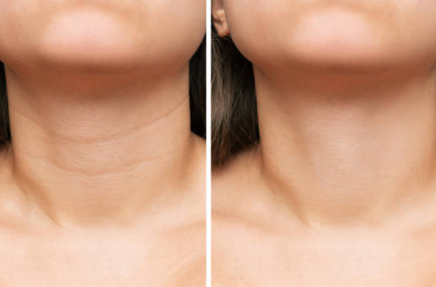 necklift in indore