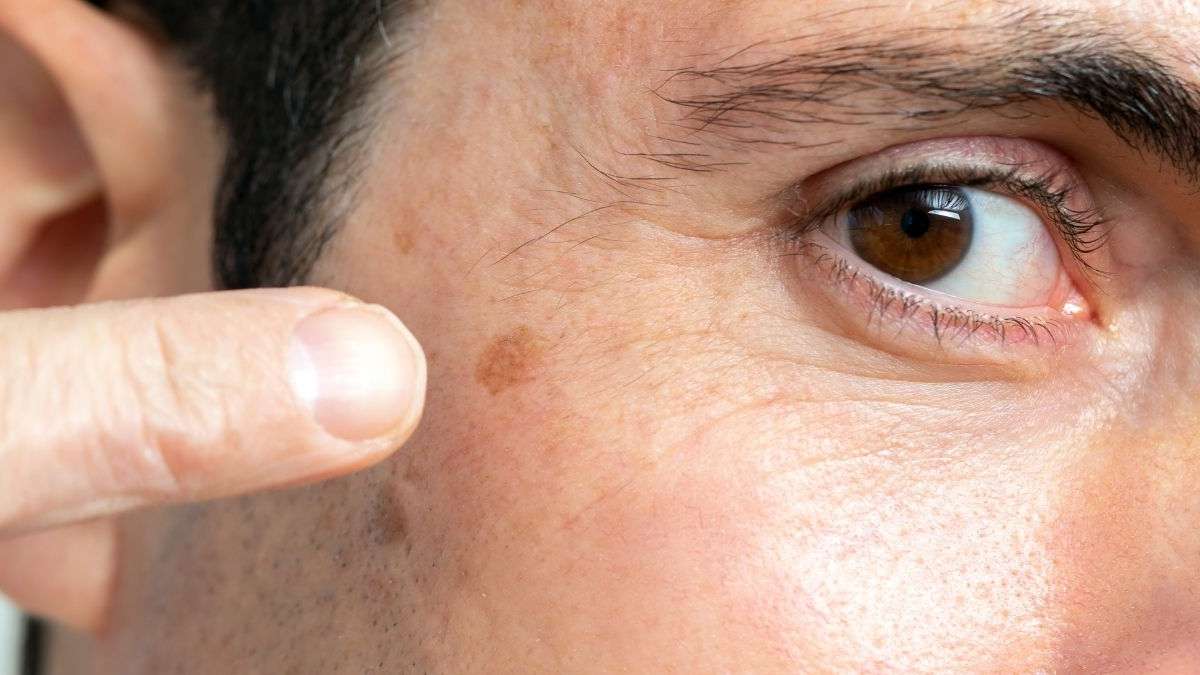 age spot treatment in indore